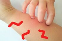 冬でもダニに刺されることがある？考えられる発生原因と対策方法とは